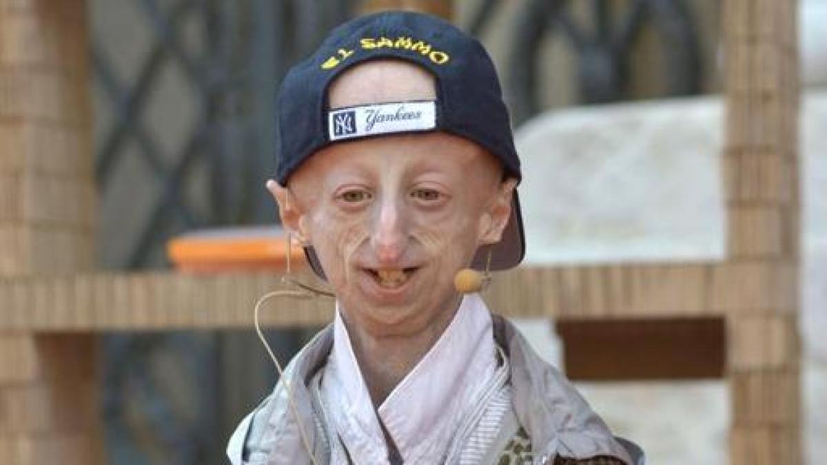 Progeria che cos è la malattia di cui soffriva Sammy Basso come viene