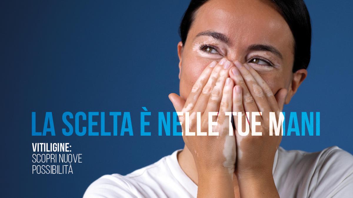 Una Campagna Di Informazione Per Chi Soffre Di Vitiligine Corriere It