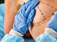 Treviso, «Perizia falsa»: guerra fra medici per un seno rifatto