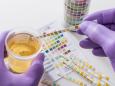 Test delle urine per i pazienti con tumore alla vescica: come esame di controllo al posto della cistoscopia
