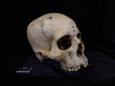 Un cranio di 4.000 anni fa racconta come gli antichi egizi tentavano di curare il cancro con la chirurgia