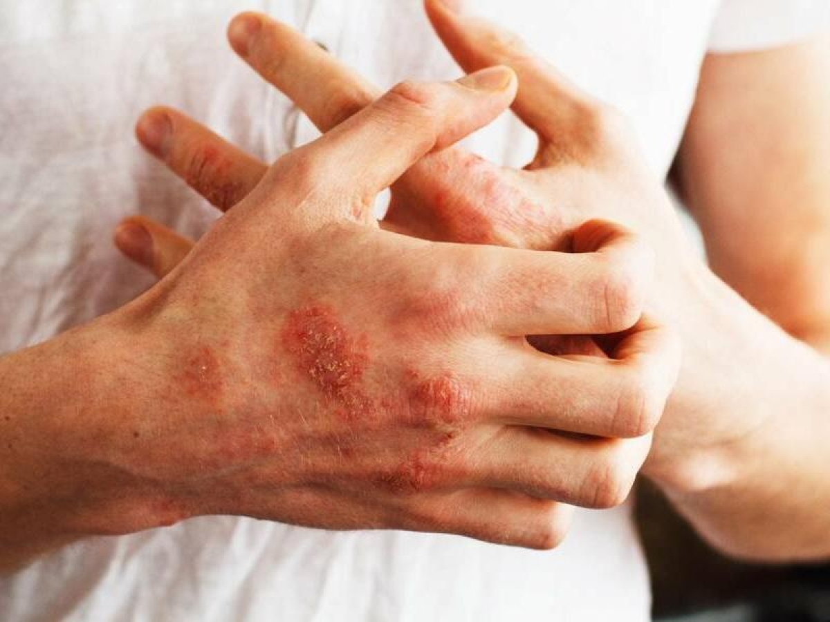 Giornata mondiale psoriasi: «Più consapevolezza su una condizione troppo banalizzata come problema estetico»