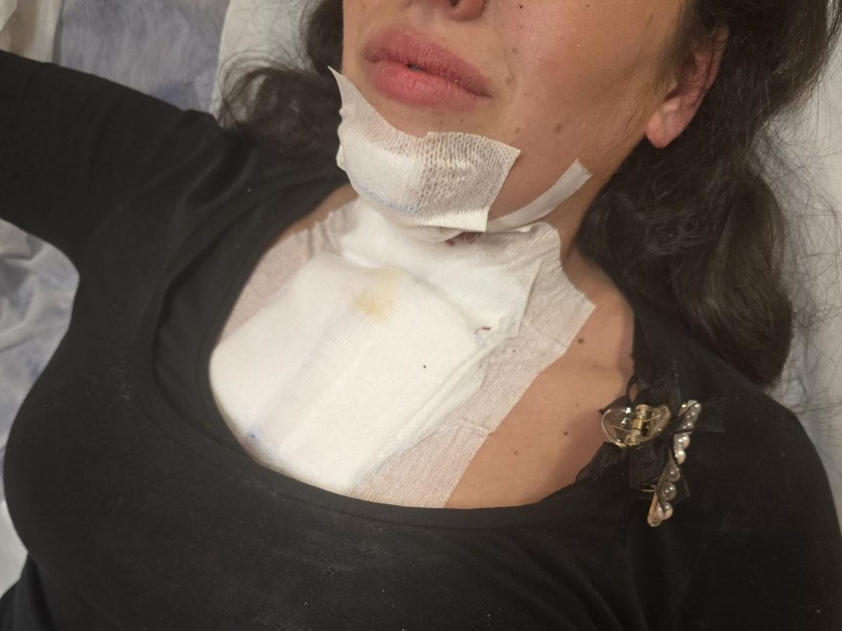 Napoli, sassi dal cavalcavia contro le auto sulla statale 268. Un conducente: «Pietra arrivata sul parabrezza: mia moglie ferita, ho temuto morisse»