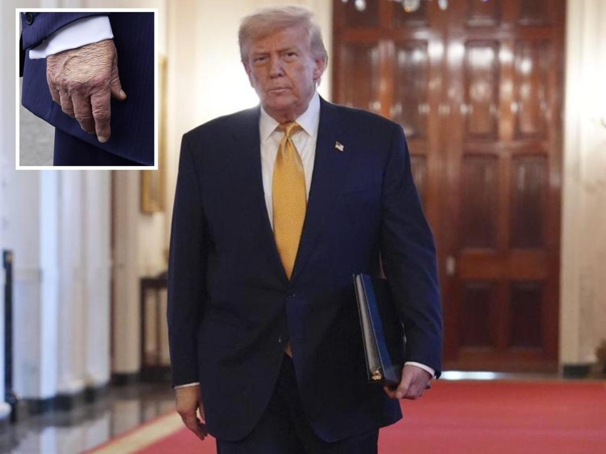 Trump e i lividi sulla mano, la Casa Bianca: «Comune insufficienza venosa». E lui rassicura: io il presidente più sano