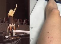 Pipistrello morde la cantante durante il tour degli AC/DC