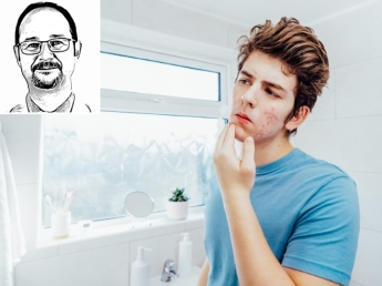 Acne in adolescenza difficile da curare: quali sono le terapie efficaci?