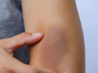 Trombosi ascellare: inizia con un livido. Riconoscere i sintomi per intervenire subito