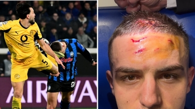 Krstovic mostra i tagli alla testa dopo il rigore procurato che ha deciso Atalanta-Borussia Dortmund