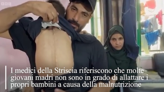 La Bbc mostra i bambini malnutriti di Gaza: le immagini dall'ospedale Nasser
