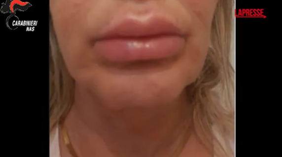 Bergamo, botox e filler con prodotti scadenti: denunciata 42enne che eseguiva interventi di estetica senza essere medico