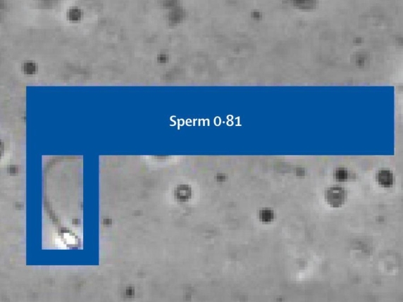 La prima gravidanza con l'Intelligenza artificiale: «Ha trovato gli unici due spermatozoi "attivi" di un 39enne»