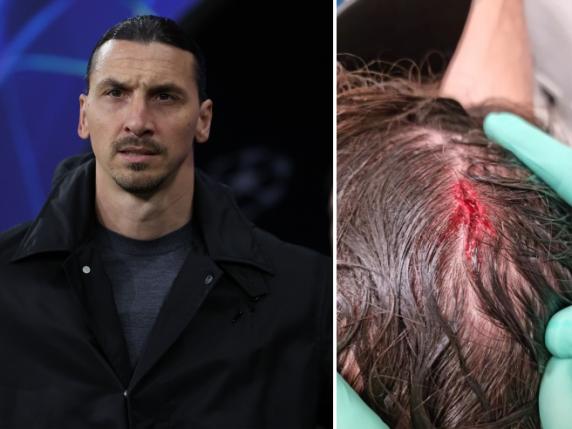 Ibrahimovic con un taglio in testa: la foto sui social. «Fa parte del gioco»