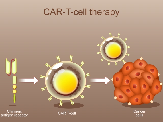 Linfomi: estesa copertura CAR‑T per pazienti senza risposta alla prima terapia
