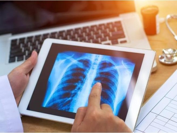 Screening del tumore al polmone: la diagnosi precoce salva vite