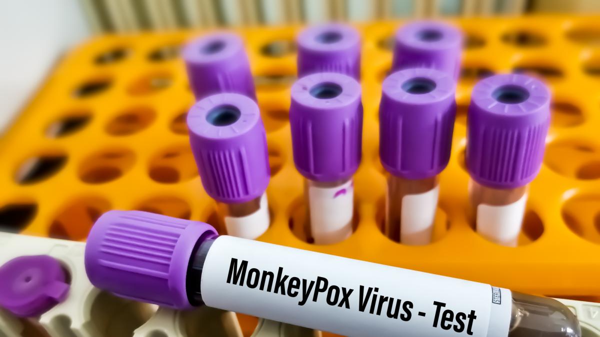 Monkeypox, Circular del Ministerio de Salud: No se recomienda viajar a países donde se han confirmado brotes de la enfermedad