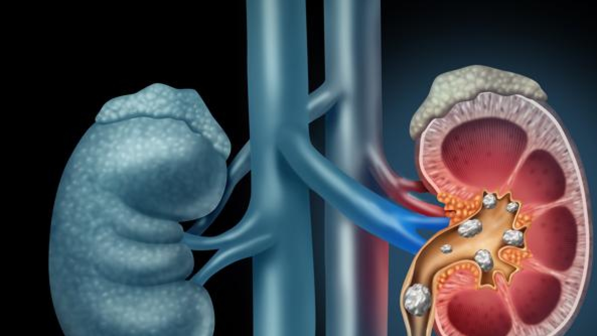 I calcoli urinari responsabili della metà dei ricoveri urologici nei pronto soccorso