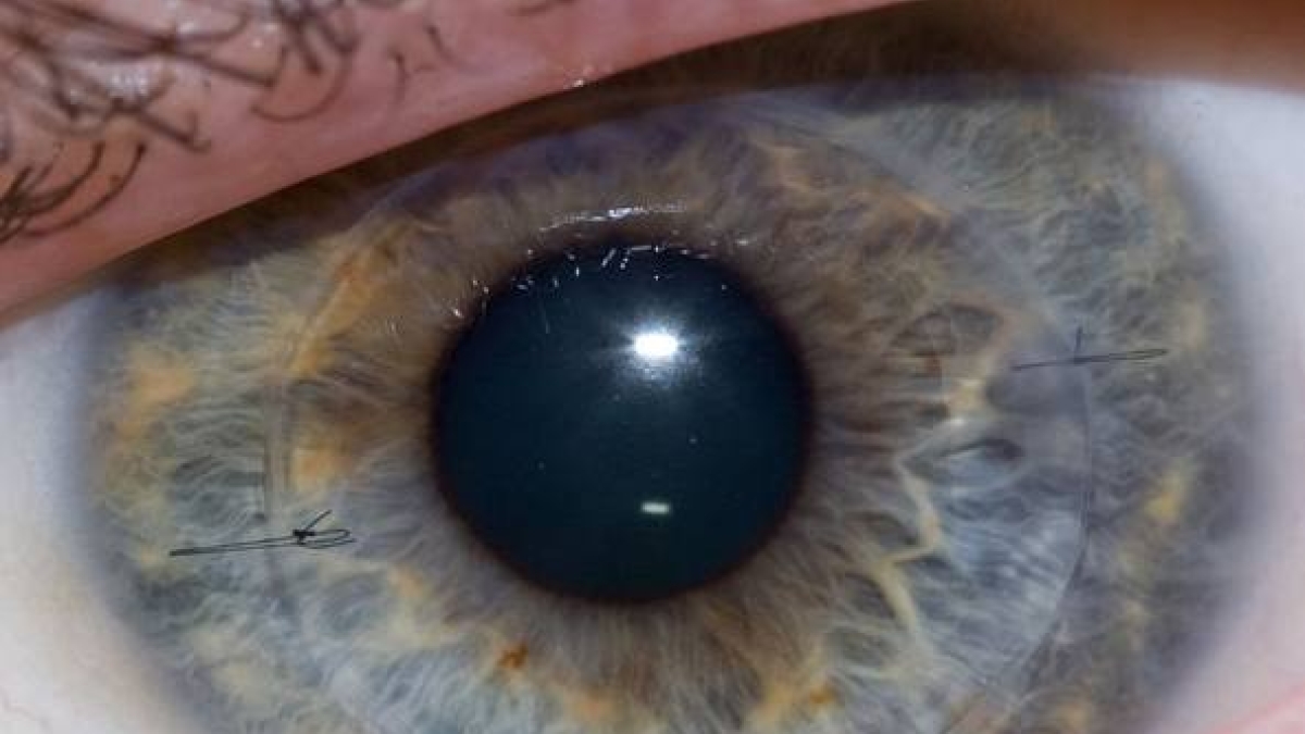 Centro Regionale Trapianti della Campania: si punta a 144 nuovi medici abilitati al prelievo di tessuti corneali per la “Banca Occhi”