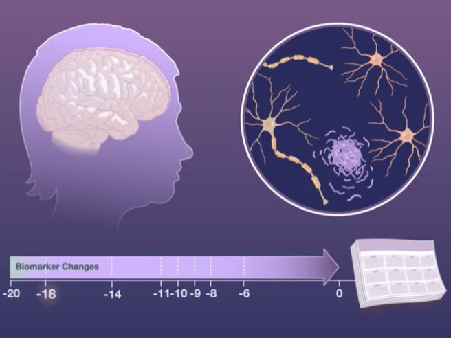 I cambiamenti sileziosi nel cervello che precedono l'Alzheimer (anche 14 anni prima dei sintomi) 