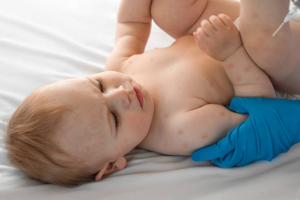 Morbillo, allarme epidemia in Gran Bretagna (e in Europa). E in Italia?