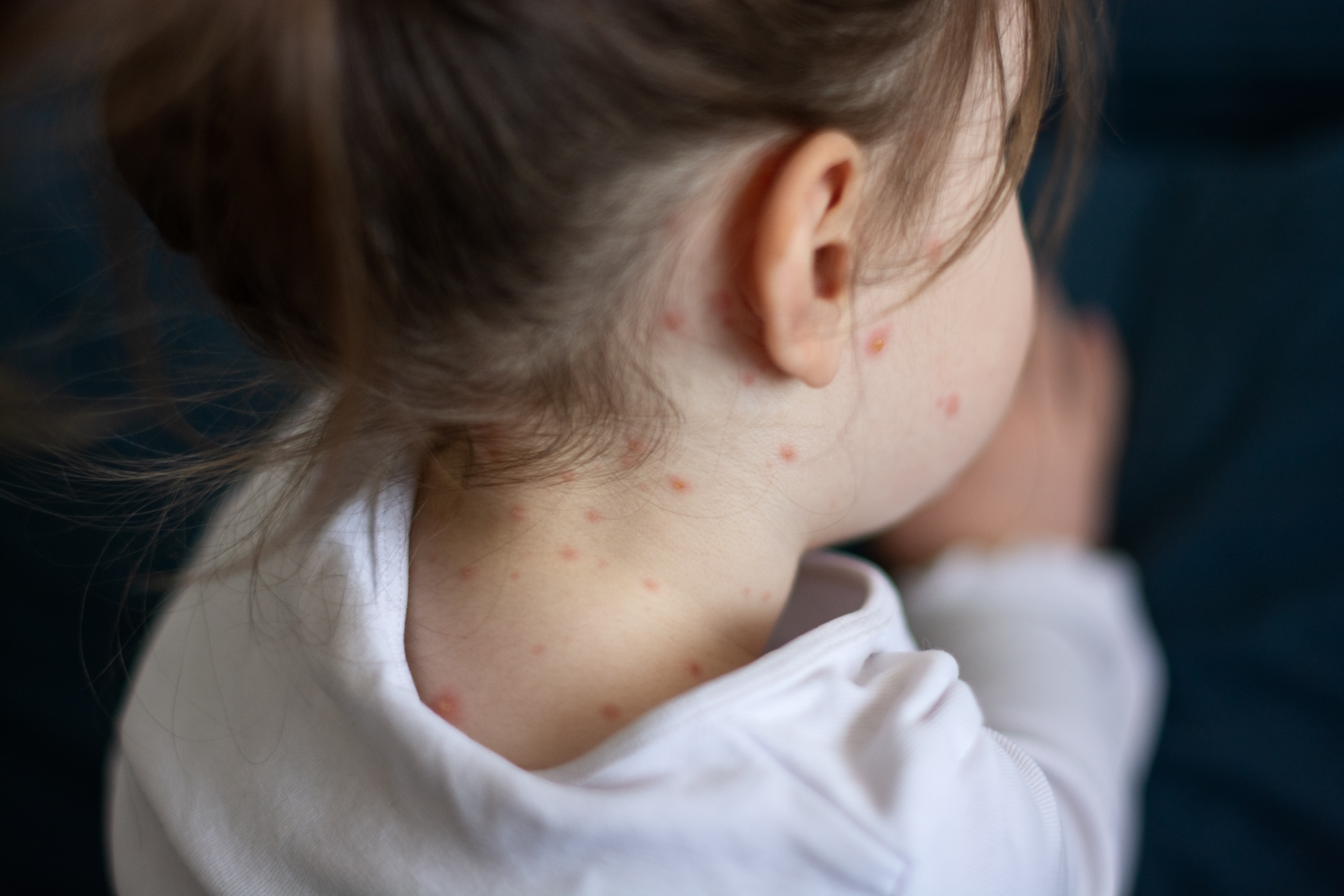 Morbillo: casi in aumento anche in Italia per calo vaccinazioni