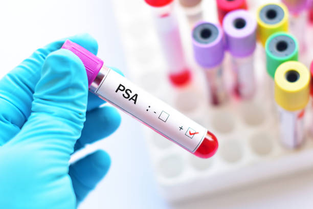 Tumore alla prostata: a chi serve davvero il test del Psa